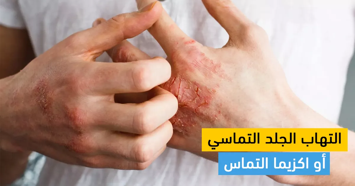 التهاب الجلد التماسي أو اكزيما التماس